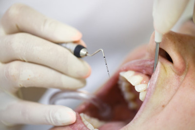 dental wisdom tooth extraction